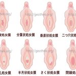 処女膜の種類イラスト