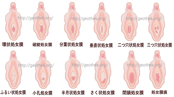 処女膜の種類イラスト